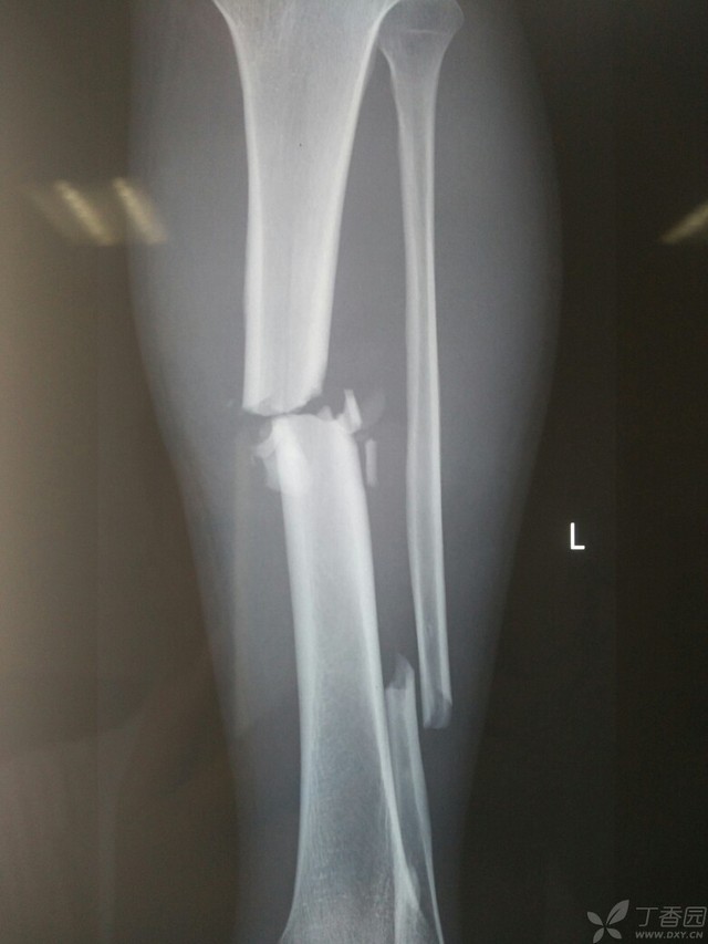 科技重塑脛腓骨骨折康復(fù)之旅，引領(lǐng)未來體驗(yàn)新篇章