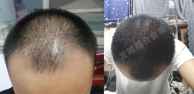 治愈脫發(fā)最新重大突破，重塑自信，希望之光再現(xiàn)