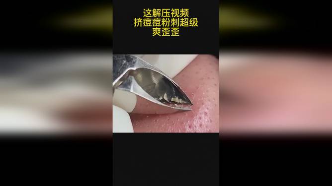 最新擠膿包視頻，見證變化的力量，自信與成就感的誕生之地